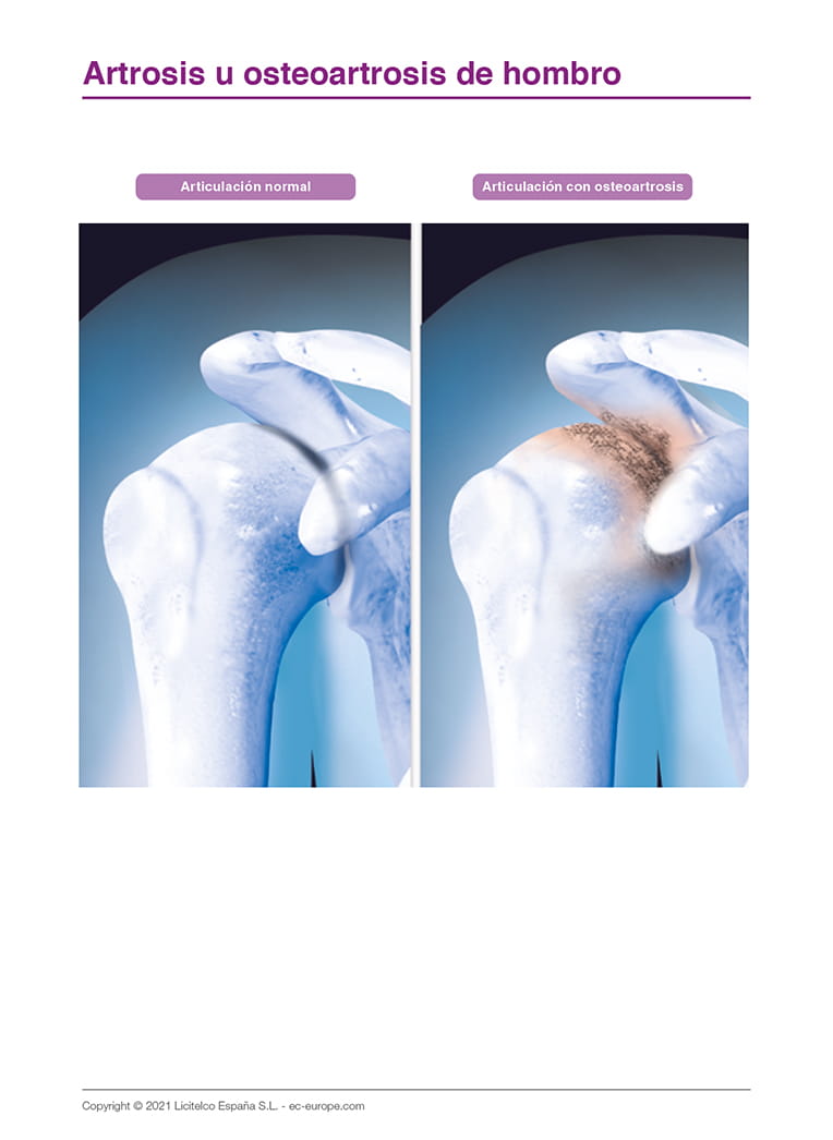 Artrosis u osteoartrosis de hombro II