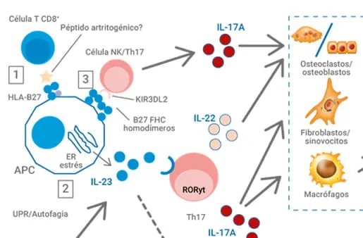 Conoce la Espondilitis Anquilosante