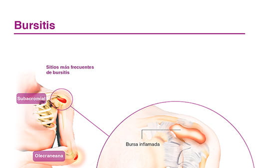 Bursitis