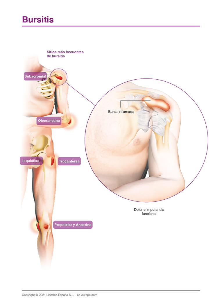 Bursitis