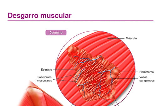 Desgarro muscular