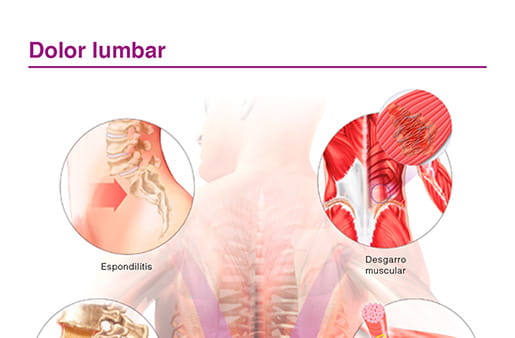 Dolor lumbar