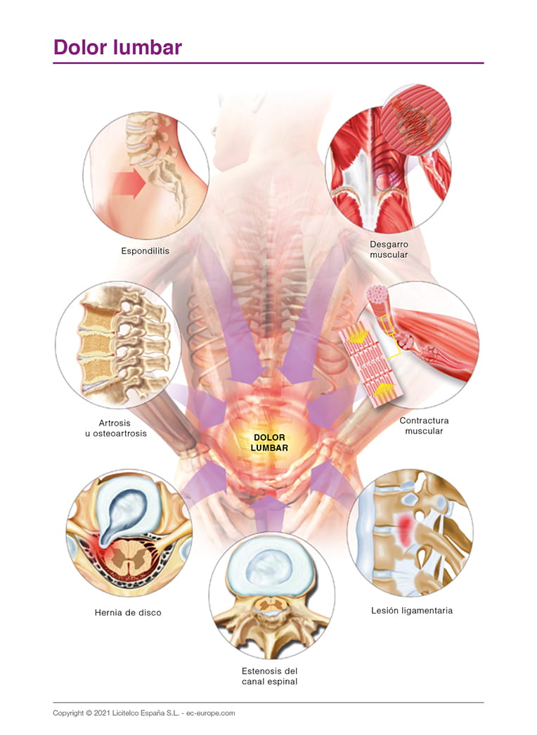 Dolor lumbar
