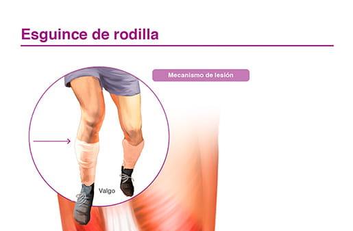 Esguince de rodilla