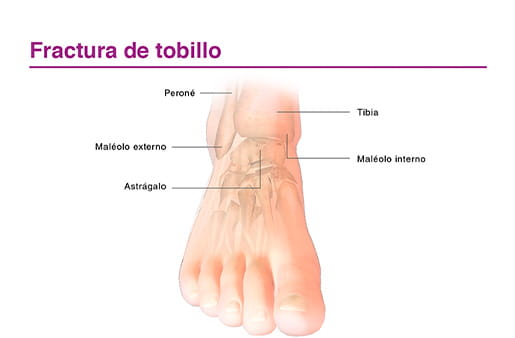 Fractura de tobillo