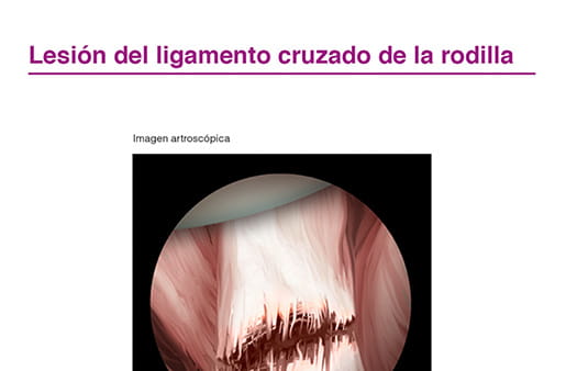 Lesión de ligamento cruzado de la rodilla