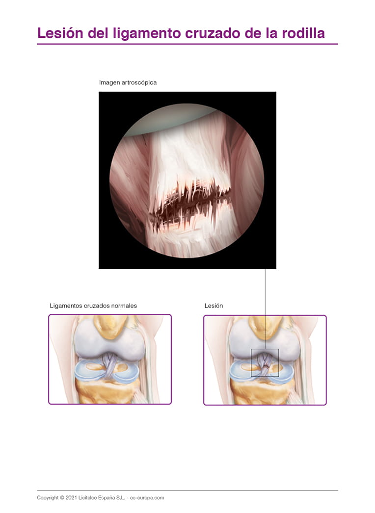 Lesión de ligamento cruzado de la rodilla