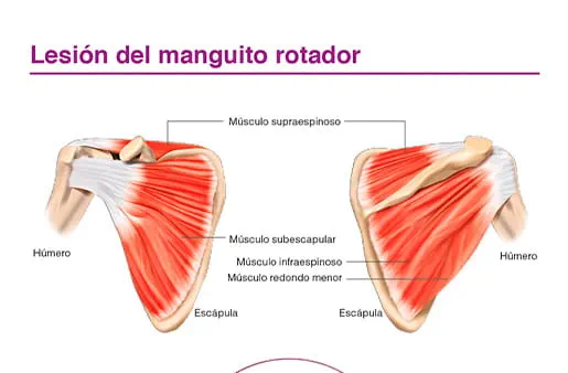 Lesión del manguito rotador