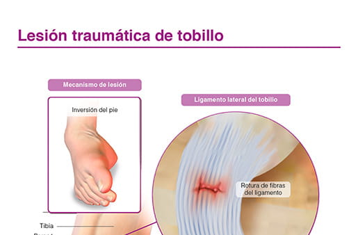 Lesión traumatica de tobillo