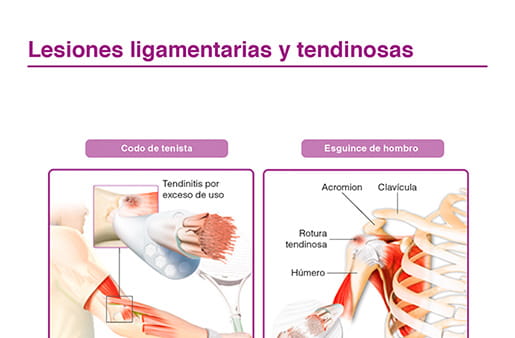 Lesiones ligamentarias y tendinosas