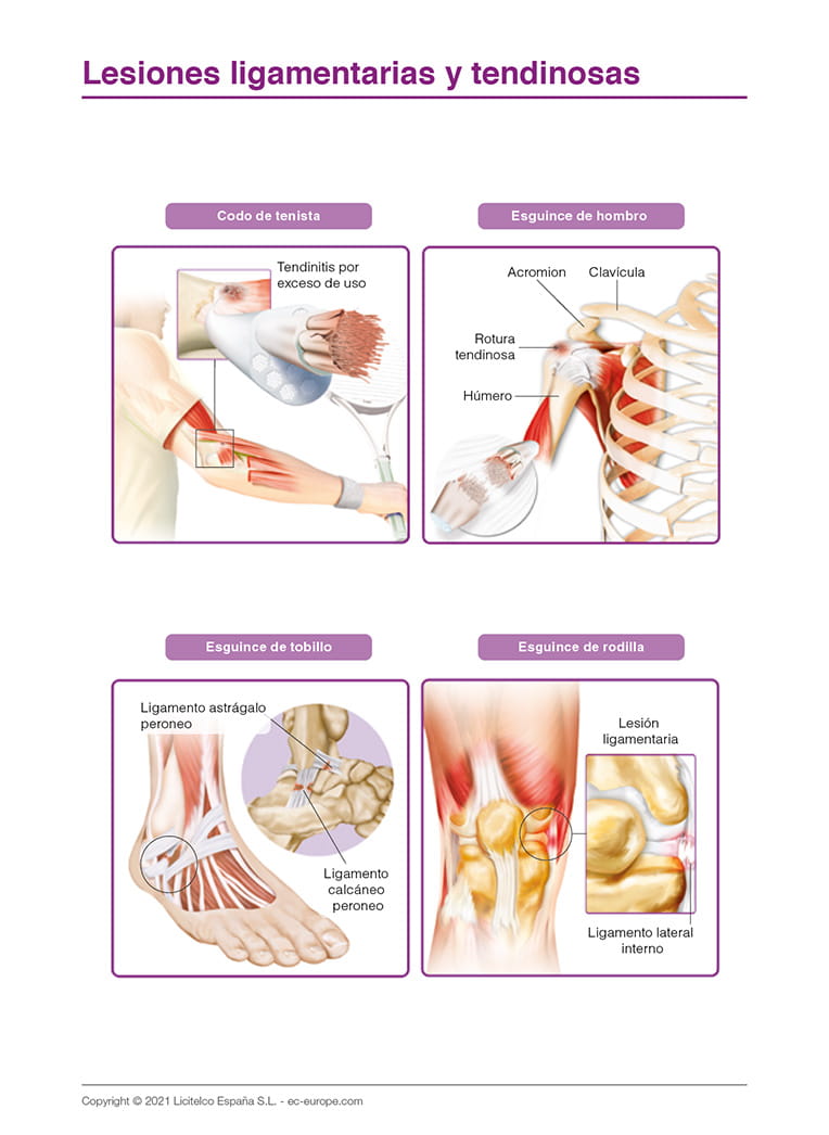 Lesiones ligamentarias y tendinosas
