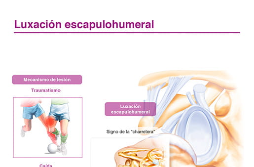 Luxación escapulohumeral