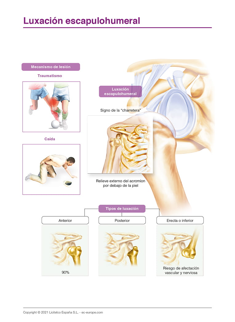 Luxación escapulohumeral