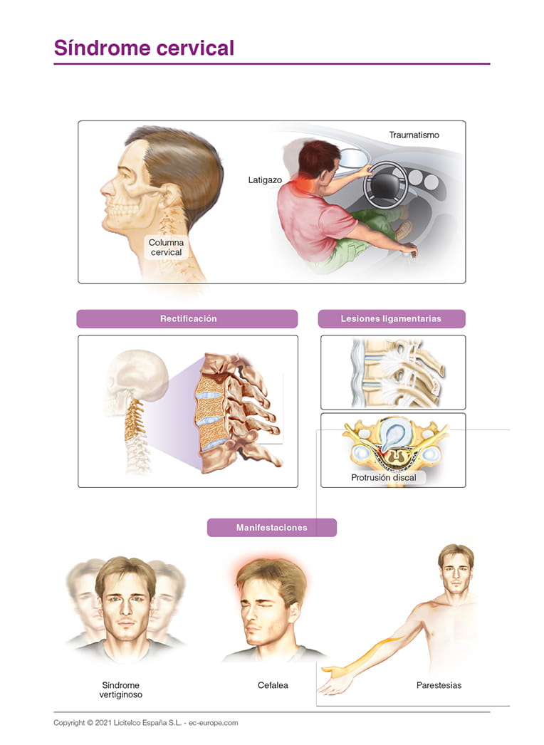 Síndrome cervical