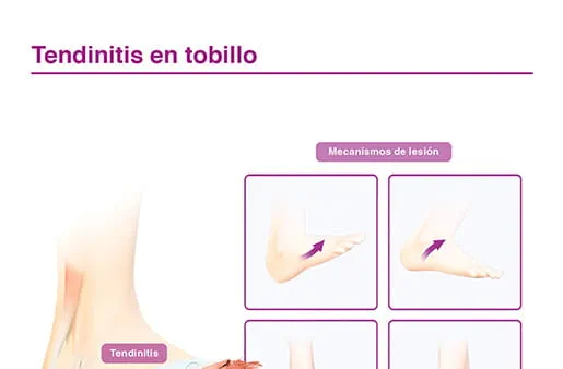 Tendinitis en tobillo