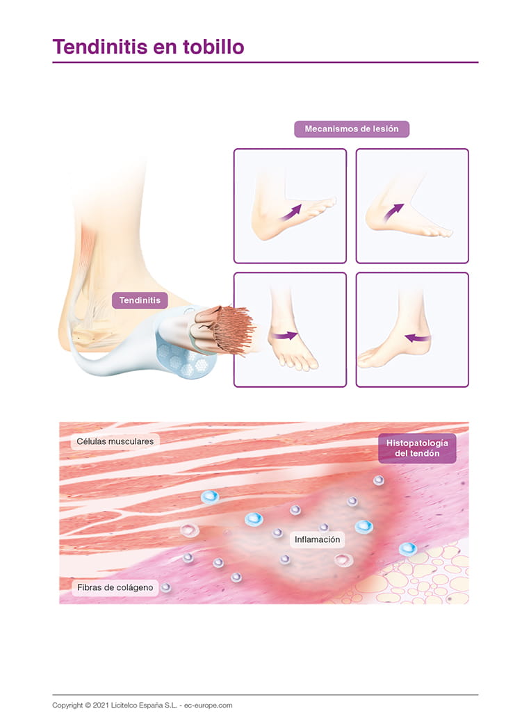 Tendinitis en tobillo