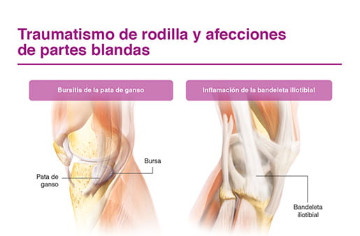 Traumatismo de rodilla y afecciones de partes blandas