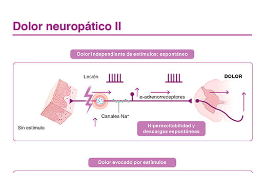 Dolor neuropático II