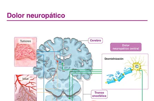 Dolor neuropático