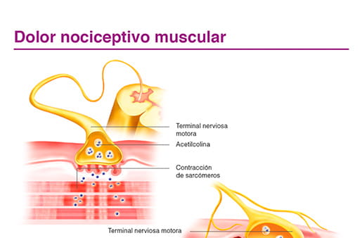 Dolor nociceptivo muscular