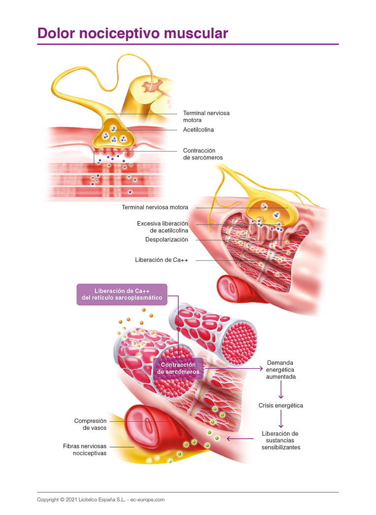 Dolor nociceptivo muscular