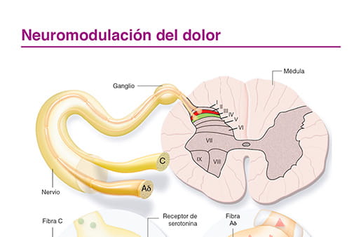 Neuromodulación del dolor