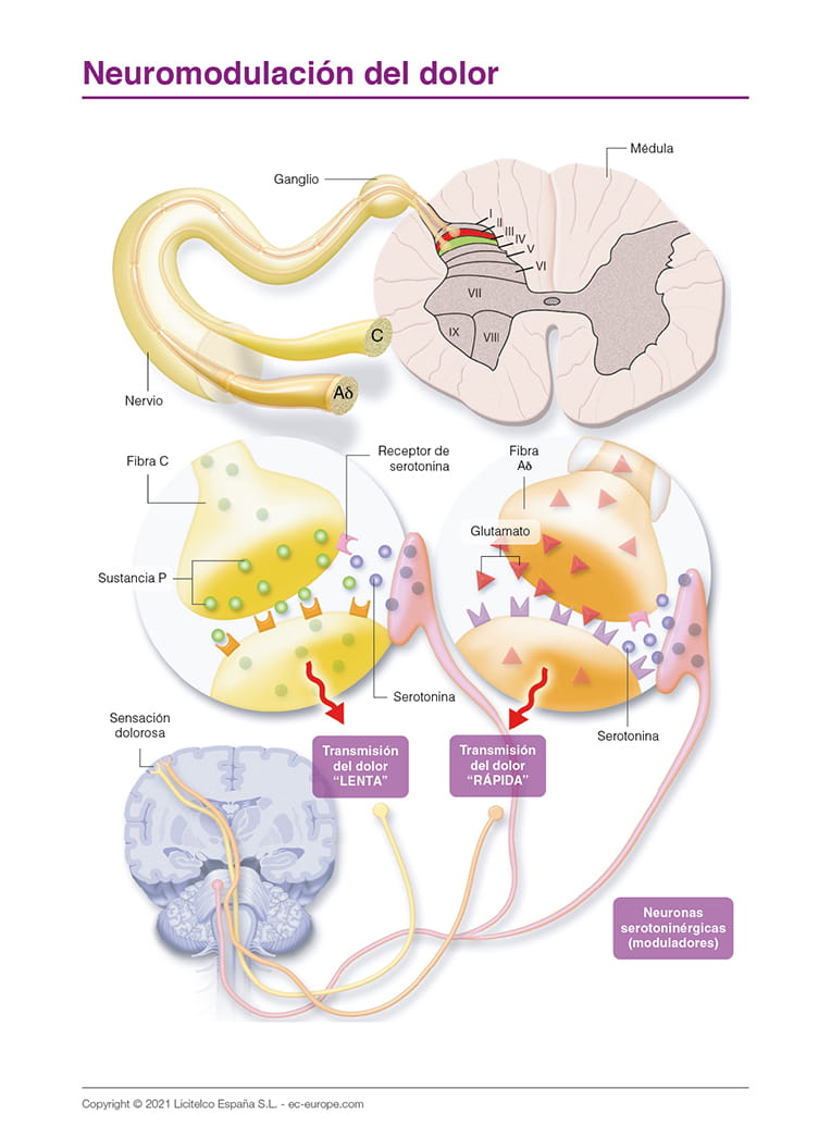 Neuromodulación del dolor