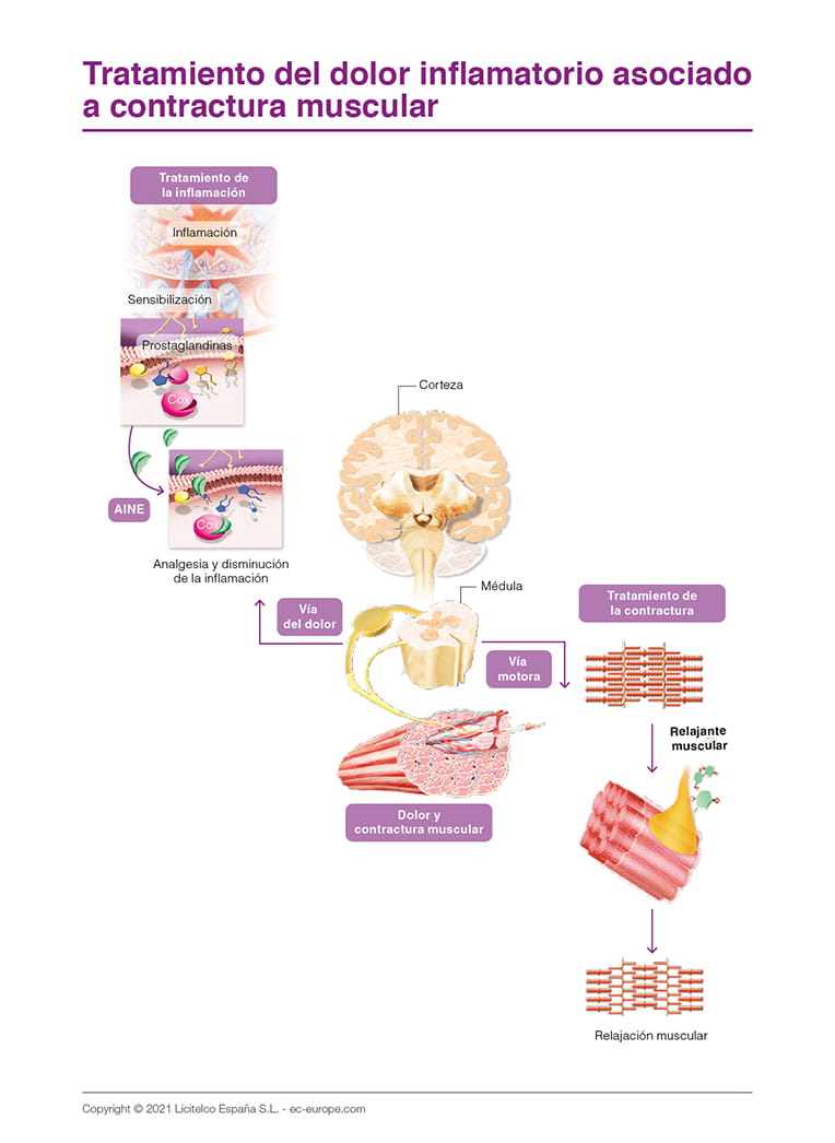 Tratamiento del dolor inflamatorio asociado a contractura muscular