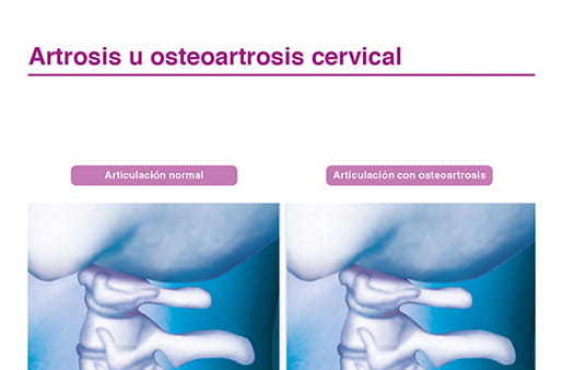 Artrosis u osteoartrosis cervical