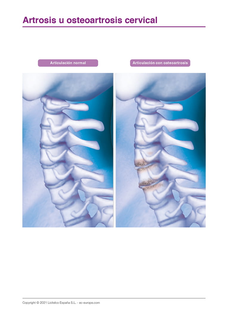 Artrosis u osteoartrosis cervical