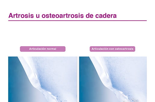 Artrosis u osteoartrosis de cadera II