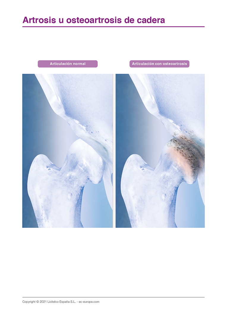 Artrosis u osteoartrosis de cadera II