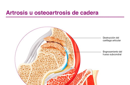 Artrosis u osteoartrosis de cadera