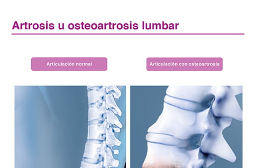 Artrosis u osteoartrosis de columna lumbar II