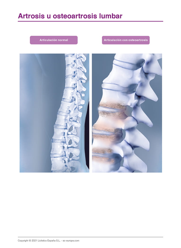 Artrosis u osteoartrosis de columna lumbar II