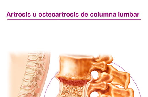 Artrosis u osteoartrosis de columna lumbar