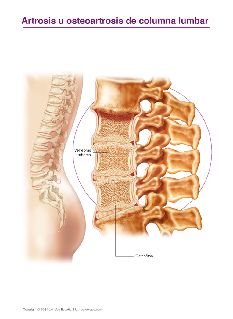 Artrosis u osteoartrosis de columna lumbar