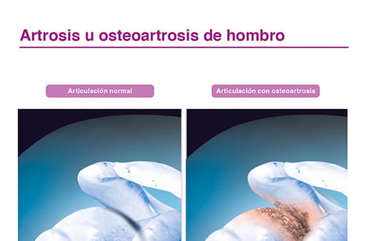 Artrosis u osteoartrosis de hombro II