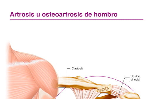 Artrosis u osteoartrosis de hombro