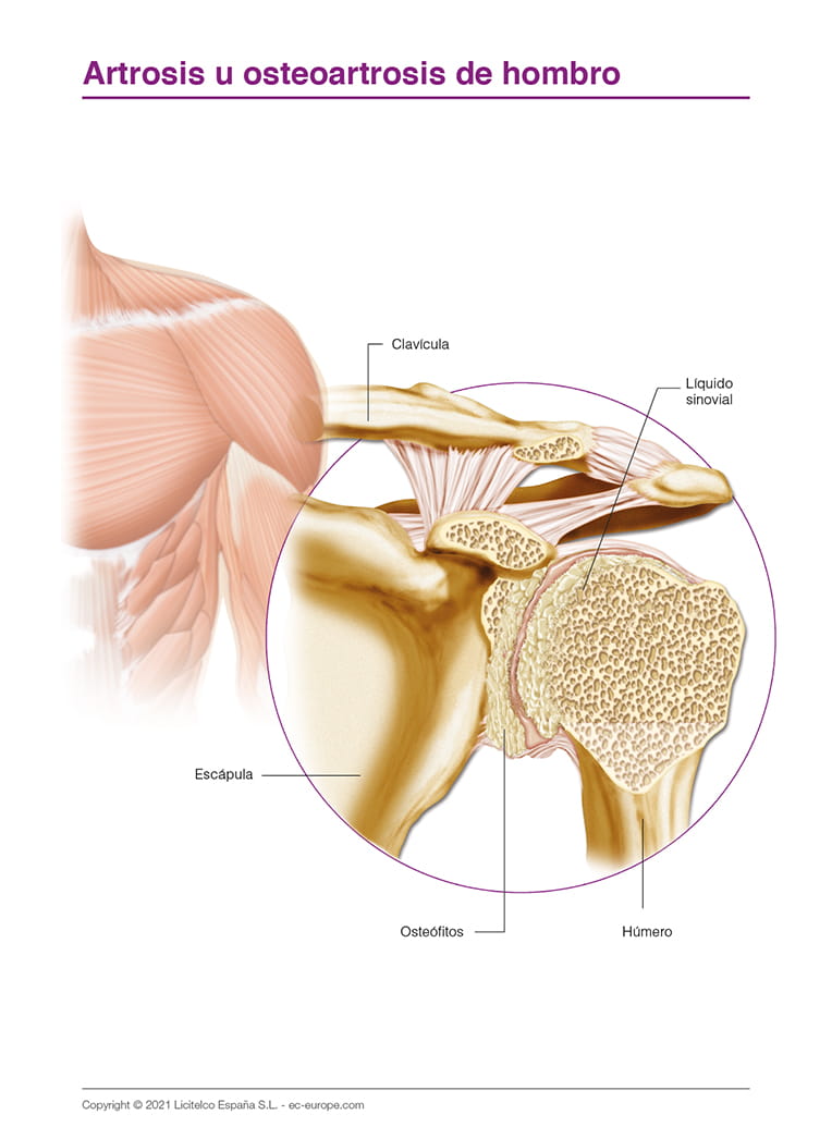 Artrosis u osteoartrosis de hombro 