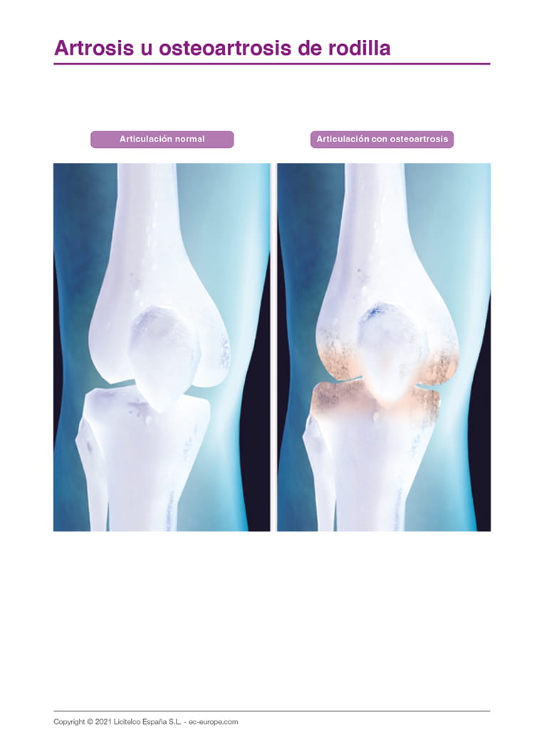 Artrosis u osteoartrosis de rodilla II