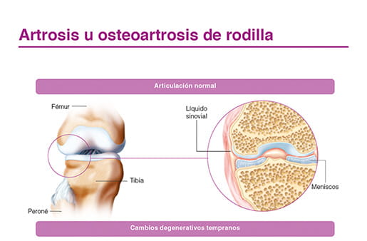 Artrosis u osteoartrosis de rodilla 