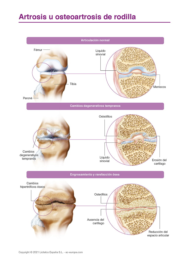 Artrosis u osteoartrosis de rodilla