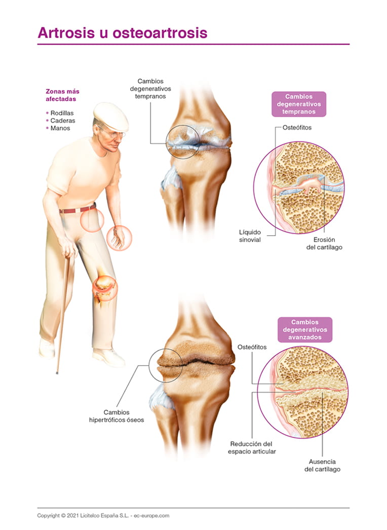 Artrosis u osteoartrosis