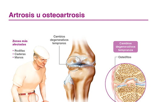 Artrosis u osteoartrosis
