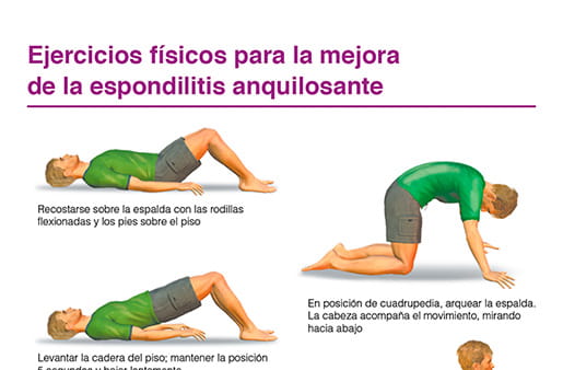 Ejercicios físicos para la mejora de la espondilitis anquilosante