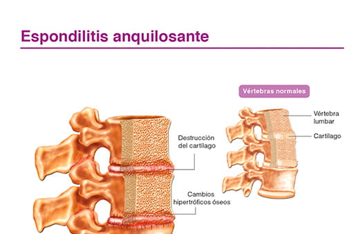 Espondilitis anquilosante