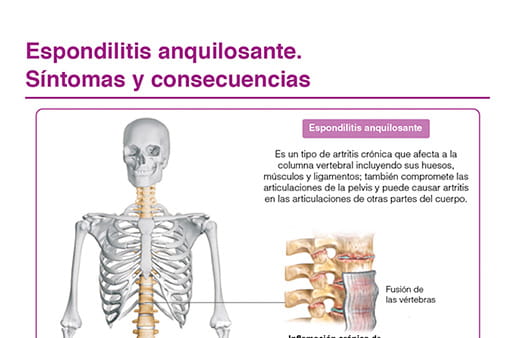 Espondilitis anquilosante. Síntomas y consecuencias