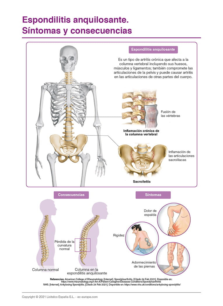 Espondilitis anquilosante. Síntomas y consecuencias