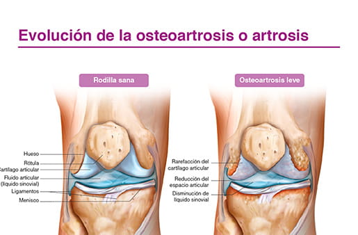 Evolución de la osteoartrosis o artrosis